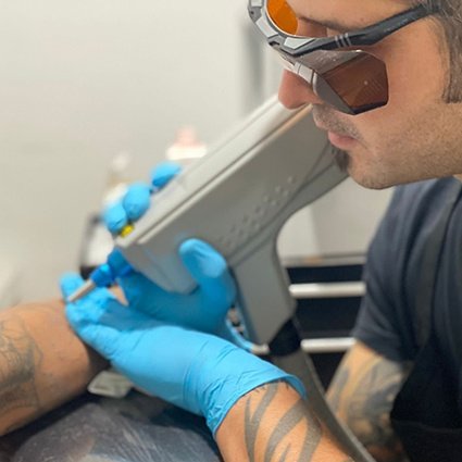 Eliminación de tatuajes con láser en Lleida